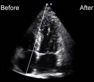 Ecograf Doppler color Apogee 5800 Genius
