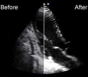 Ecograf Doppler color Apogee 5800 Genius