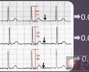 Electrocardiograf pediatric Zoncare IMAC 1500