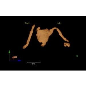 Ecograf Doppler color Apogee 5800 Genius