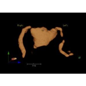 Ecograf Doppler color Apogee 5800 Genius