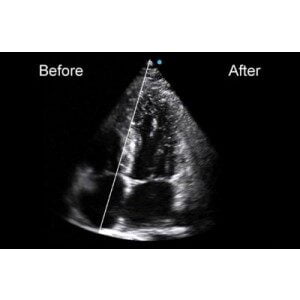 Ecograf Doppler color Apogee 5800 Genius