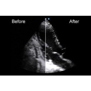 Ecograf Doppler color Apogee 5800 Genius