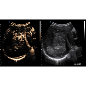 Ecograf Doppler color Apogee 5800 Genius