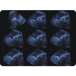 Ecograf Doppler color Apogee 5300