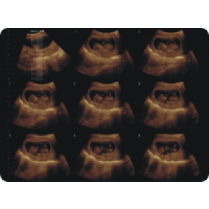 Ecograf Doppler color Apogee 5300