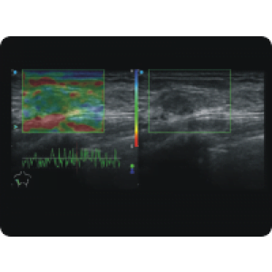 Ecograf Doppler color Apogee 5300